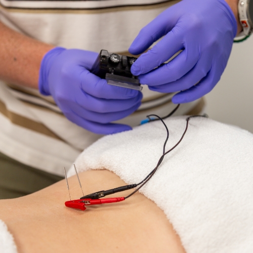 dry-needling-Langford-Sports-and-Physical-Therapy-Nob-Hill-North-Valley-Albuquerque-NM